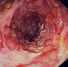 Crohn S Disease Symptoms Causes Diagnosis Crohn S Disease Treatment
