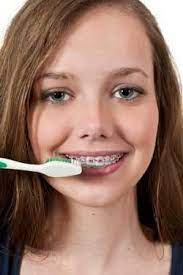 7 Tips To Prevent Ceramic Braces From Staining Ortodoncia