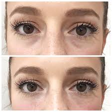 Maybe you would like to learn more about one of these? My Experience With Under Eye Filler Tessa Lindsay Garcia