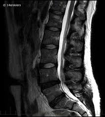 Maybe you would like to learn more about one of these? Two Herniated Discs And My Road To Recovery 14erskiers Com