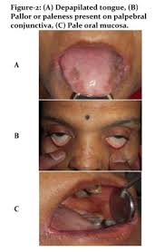 A description of this syndrome was. Health Reference Center Academic Document Plummer Vinson Syndrome