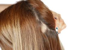 Another picture of does using hair color cause hair loss: Coronavirus Stress May Cause Shock Hair Loss Wzzm13 Com