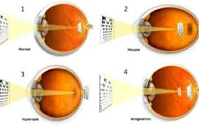 Image result for Refractive Error