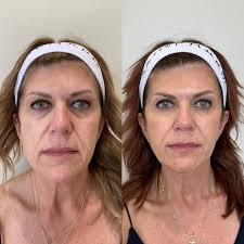 For my girlies who like to go harddd with their treatments. 😂 Giggle allll  you want but this is a common misconception when it comes...