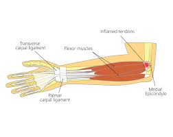 The first one is medial epicondyle of the humerus which. Medial Epicondylitis Upswing Health