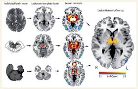 Image result for Neurologic Lesion Localization