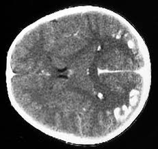 Frontiers Extra Intestinal Manifestations Of Coeliac Disease In Children Clinical Features And Mechanisms Pediatrics