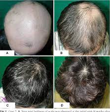 Bei diffusem haarausfall ist die gesamte kopfpartie mehr oder weniger gleichmäßig von haarverlust betroffen. Acute Diffuse And Total Alopecia A New Subtype Of Alopecia Areata With A Favorable Prognosis Semantic Scholar