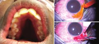 Nineteen Year Old Woman With Marfan Syndrome And Hypotony Right Eye Download Scientific Diagram