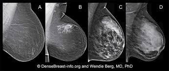She looked at the screen, looked at bret, and said, let's. Dense Breasts Answers To Commonly Asked Questions National Cancer Institute