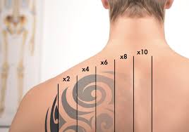 As science is progressing, tattoo removal has gained immense popularity. Laser Tattoo Removal Colorado No Regrets Laser Services