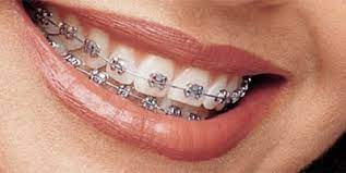 We did not find results for: Types Of Braces Dr Mike Mizell Orthodontist