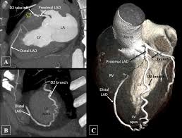 The coronary arteries are the only branches of the lad coronary artery supplies blood to the anterior left ventricular wall through its diagonal as seen, coronary artery anomalies may involve abnormalities of number, origin and/or course. Auto Collateral From The Second Diagonal Branch To The Left Anterior Descending Artery Bmj Case Reports