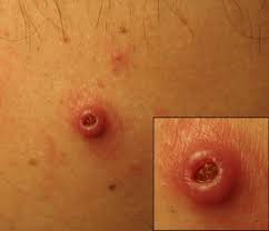 The human bot fly, dermatobia hominis (linnaeus jr., 1781), is a large, densely haired fly that looks like a bumblebee (kahn. Simple And Effective Field Extraction Of Human Botfly Dermatobia Hominis Using A Venom Extractor Sciencedirect