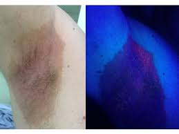 Image result for Erythrasma