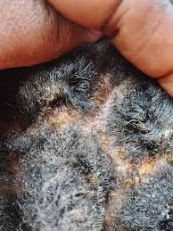 Image result for white scabs on the head in children