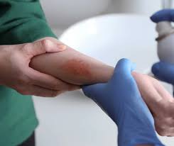 minor burn treatment