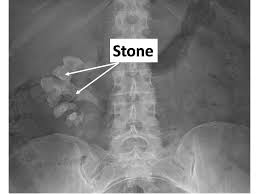 Dr Bruder Urologist 212 661 7003 50 East 42nd Street Suite 407 New York Ny 10017 Kidney Kidneystone Urology Kidney Stones Remedy Kidney Stones Kidney