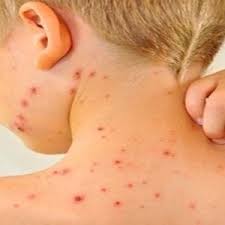 Image result for shingles in children