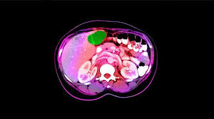 Check spelling or type a new query. Tests That Diagnose Liver Cancer Liver Cancer Center Everydayhealth Com