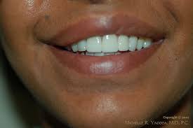 Braces can take a lot of time and multiple trips to the orthodontist's office. Patient 2 Dr Michelle Yagoda Nyc Facial Plastic Surgeon