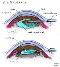 مريض المياه البيضاء في حجرة العمليات