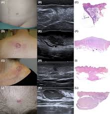 Image result for Dermatofibrosarcoma Protuberans