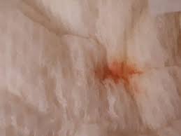 Cu toate acestea, durerea din acest domeniu poate indica nu numai boala a vezicii urinare, dar abuzul de rinichi, uretere, organele genitale, etc. Superficial Conducere Oblong Sange In Scaun La Sugari Footballswagger Com