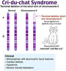 Which Syndrome Is Assoc W A Terminal Deletion Short Arm