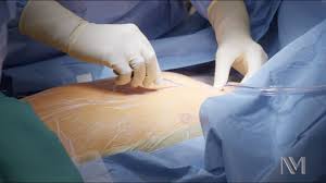 Surgery synonyms, surgery pronunciation, surgery translation, english dictionary definition of surgery. Open Heart Surgery Inside The Or Youtube