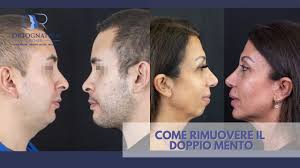 Doppio mento: cos'è e i trattamenti per eliminarlo