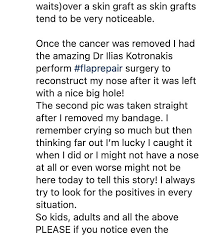 Well, unfortunately there isn't one. Married At First Sight Australia S Lauren Huntriss Reveals She Had Skin Cancer Removed From Nose Readsector Female