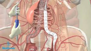 Aneurysms that involve the aorta as it flows thru both the abdomen and chest are called thoracoabdominal aortic aneurysms. Operatie Aneurysma Van De Buikslagader Evar Procedure Youtube