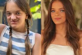 Rafaella Justus realiza procedimento e rosto se destaca: 'amei demais'; ela  mostrou o antes e depois.........