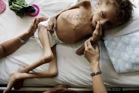 One Mln Children In Africa Suffer Malnutrition Un Says Republika Online