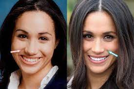 We're sorry, this service is currently. Cirugia Plastica Meghan Markle Trabajo De Nariz Dientes Antes Y Despues Antes Cirugia De Despues Dientes Markle Meghan Nar ç¾Žå®¹æ•´å½¢ ãƒ¡ãƒ¼ã‚¬ãƒ³ãƒžãƒ¼ã‚¯ãƒ« ãƒ¡ã‚¤ã‚¯