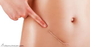 Female Inguinal Hernia Surgery What You Should Know