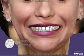 Clinical work by Mohammed Sherief and Ahmed Megahed, Lab support: Digital  Enamel Lab 🇪🇬