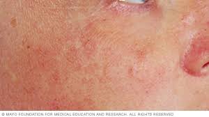 The best way to avoid skin damage from the sun is to practice proper sun protection every day. Slide Show Sun Damage Mayo Clinic