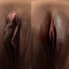 Atualmente sou a foto da esquerda. É possível consertar um clitóris grande  para ficar parecido com a foto que fiz no Photoshop à direita? : robgyn