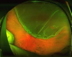 The majority of retinal breaks, holes, or tears are spontaneous, result when the vitreous gel pulls loose or separates from its attachment to the retina, usually in the peripheral parts of the retina. Floaters Retinal Tears And Retinal Detachments Visionaware