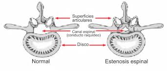 Los hallazgos en la auscultación en la estenosis mitral consisten en un s1 intenso causado por el. Estenosis De La Columna Lumbar Lumbar Spinal Stenosis Orthoinfo Aaos