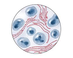 Image result for chancroid