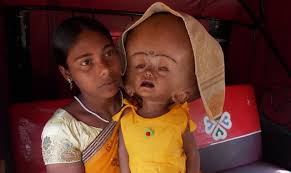 Baby with rare water on the brain condition