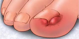 Image result for Akutní zánět nehtového lůžka