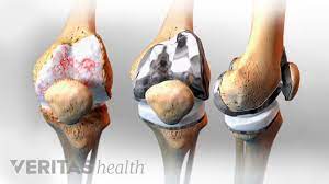 Total Knee Replacement Risks And Complications Total Knee Replacement Knee Arthritis Knee Replacement Surgery