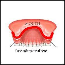 Pin Su Devo Farmi La Dentiera Fai Da Te