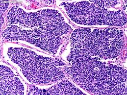 It's usually caused by smoking tobacco. Webpathology Com A Collection Of Surgical Pathology Images