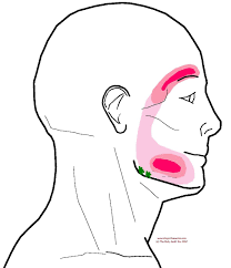 Headache In The Eyebrow Integrative Works Trigger Points Cluster Headaches Headache