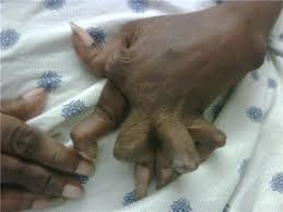 Related online courses on physioplus. Severe Rheumatoid Arthritis Hand Deformity Bmj Case Reports